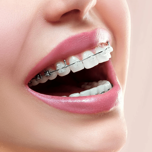 Braces (Metallic Or Tooth Colored Ceramic)