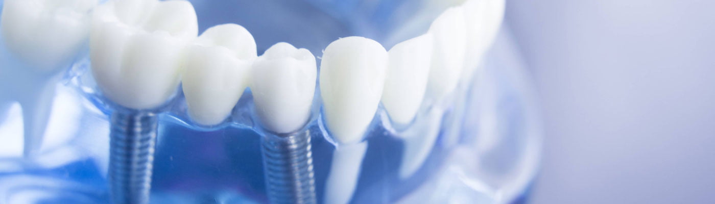 Multiple Teeth Implants