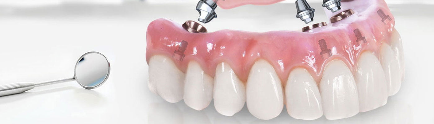 All Teeth Implants