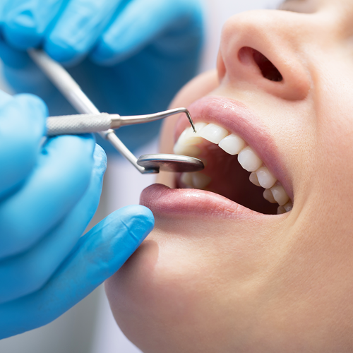 Full Mouth Scaling & Polishing