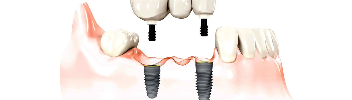 Nobel Biocare - Dental Implants