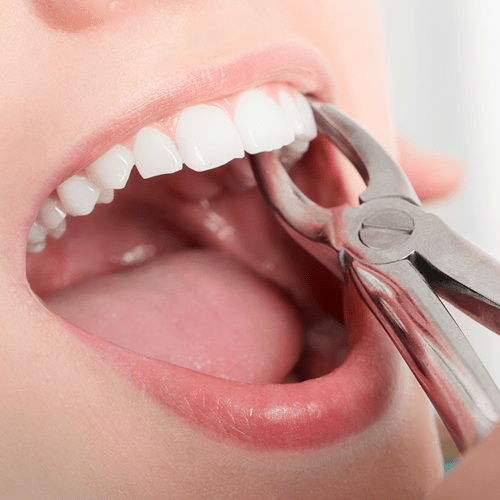 Socket Preservation Therapy