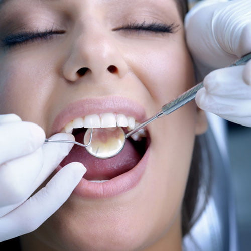 Mottling Of Teeth Correction