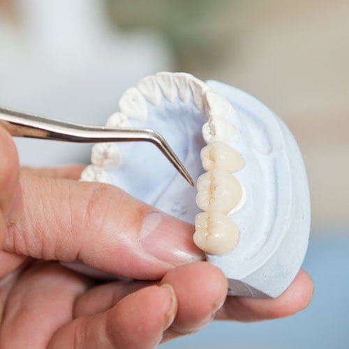 Metal Free Crowns & Bridges Laser Dentistry